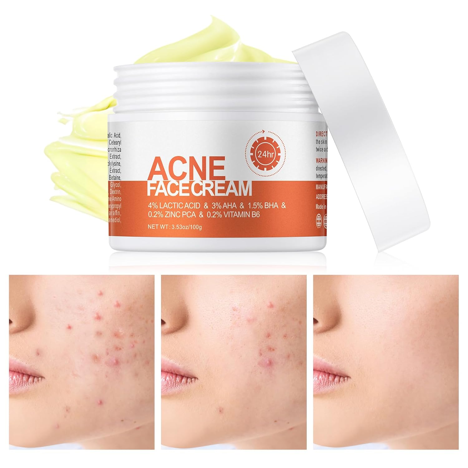 Acne Cream, Salicylic Acid Cystic Acne Treatment For Face, Back Butt Acne Treatments Creams, Acne Spot Treatment for Face Body, Acne Clearing Pimple Cream for Teens & Adults, Acne Moisturizer