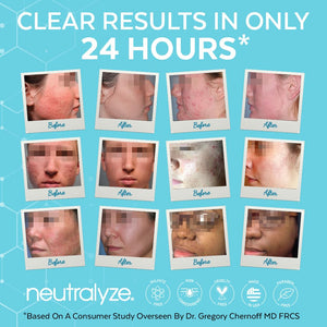 Exfoliating Acne Treatment Pads (100 Count) - Dual Textured Face Wipes with 2% Salicylic Acid & 2% Mandelic Acid - Toner Pads for Acne Prone Skin, Face & Body Wipes for Teens & Adults