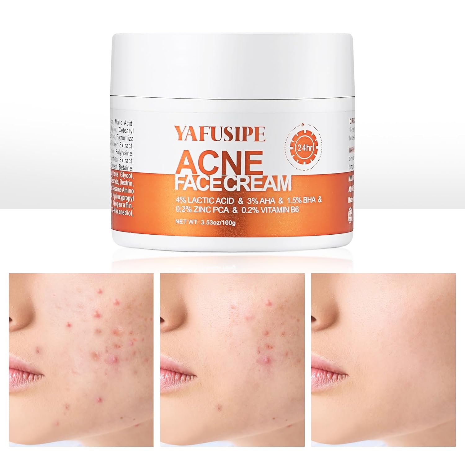 Acne Treatment Cream for Face & Body - Anti-acne Moisturizer for Teens & Adults - Spot Treatment for Breakouts & Blemishes - 30g