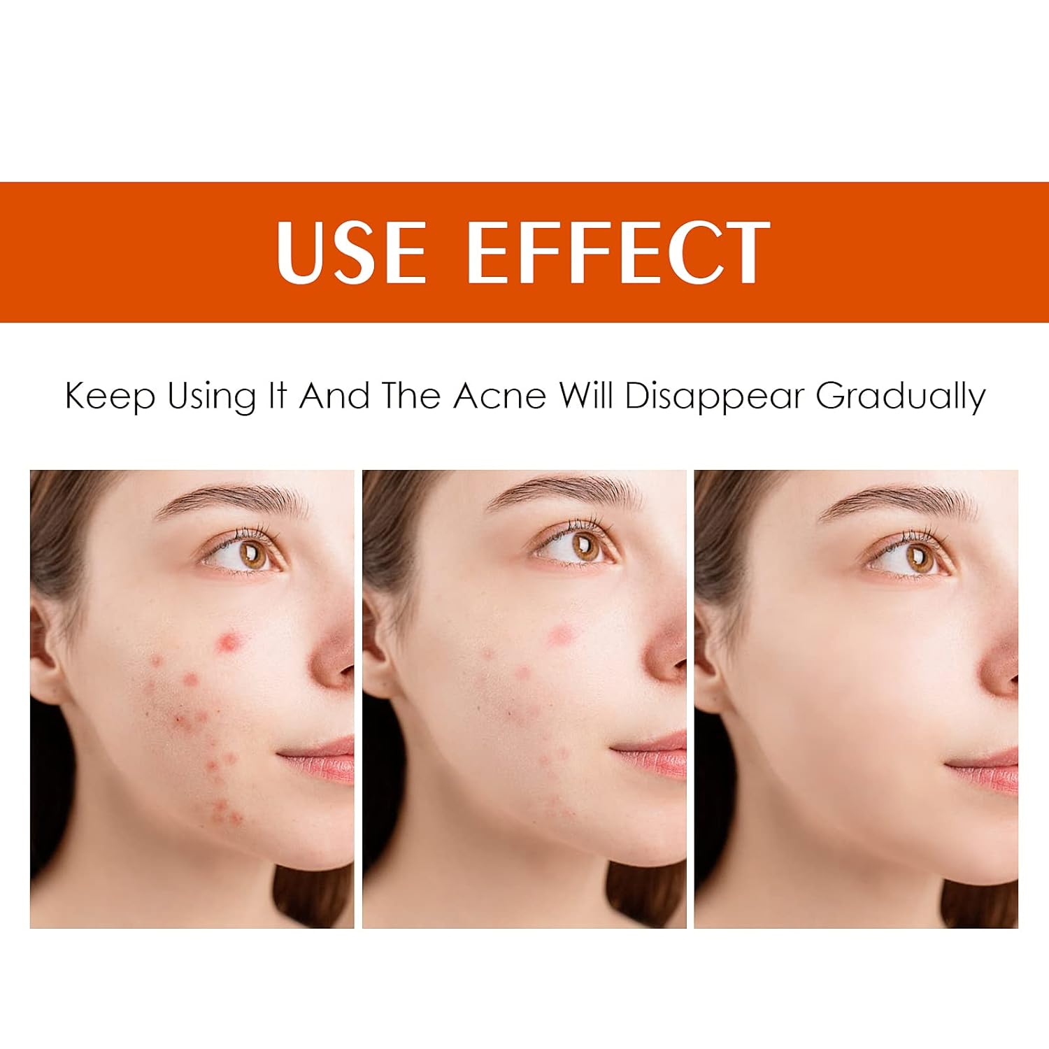 Acne Treatment Cream for Face & Body - Anti-acne Moisturizer for Teens & Adults - Spot Treatment for Breakouts & Blemishes - 30g