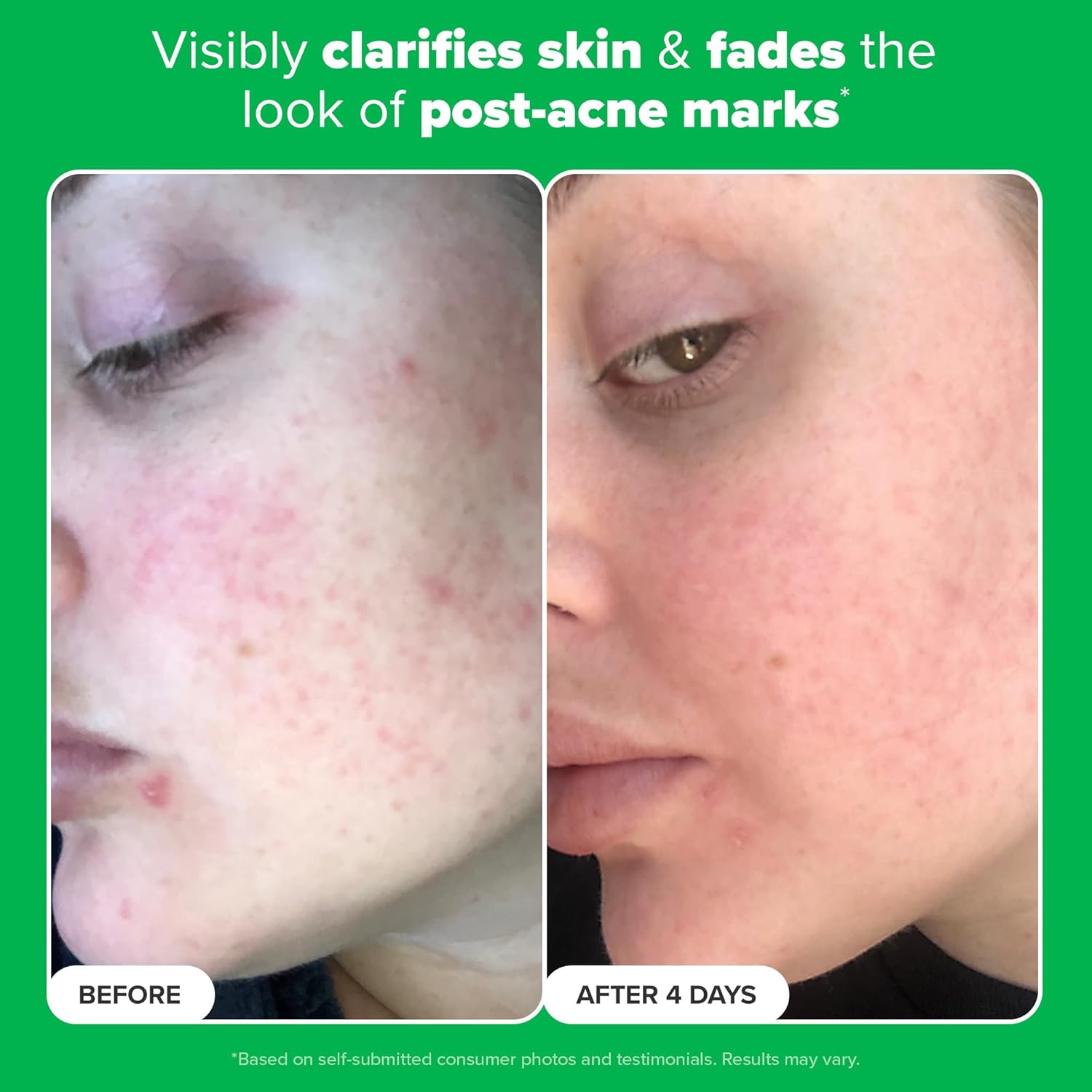 Paula's Choice BOOST 10% Azelaic Acid Booster Cream Gel, Licorice Extract & Salicylic Acid, Oil-Free Skin Brightening Serum