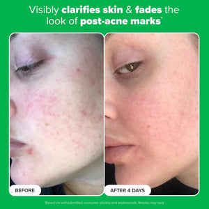 Paula's Choice BOOST 10% Azelaic Acid Booster Cream Gel, Licorice Extract & Salicylic Acid, Oil-Free Skin Brightening Serum