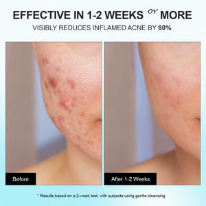 Acne Pimple Spot Treatment Cream: Cystic Hormonal Blackheads Blemish Remover for Face, Back and Body - with 10% Azelaic Acid - Teens 13-19 & Young Adult 20-30, 1.8 oz