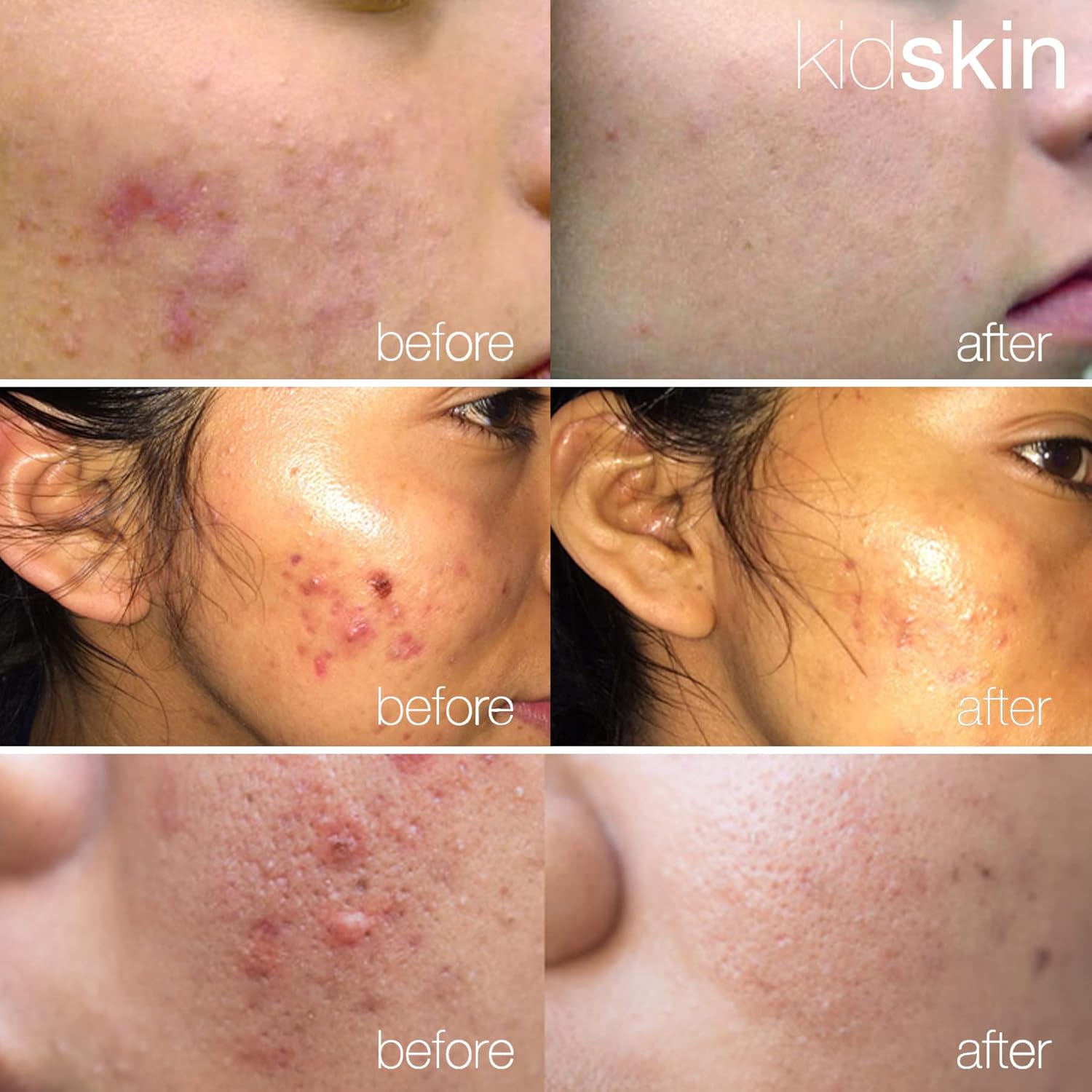 Kidskin - Z-Blast Serum, for Face Acne, Skin Care for Kids, Pre-Teen and Teen Skin Ages 9-17, Vegan-and-Cruelty-Free Acne Prone Skin Care, 1 fl oz