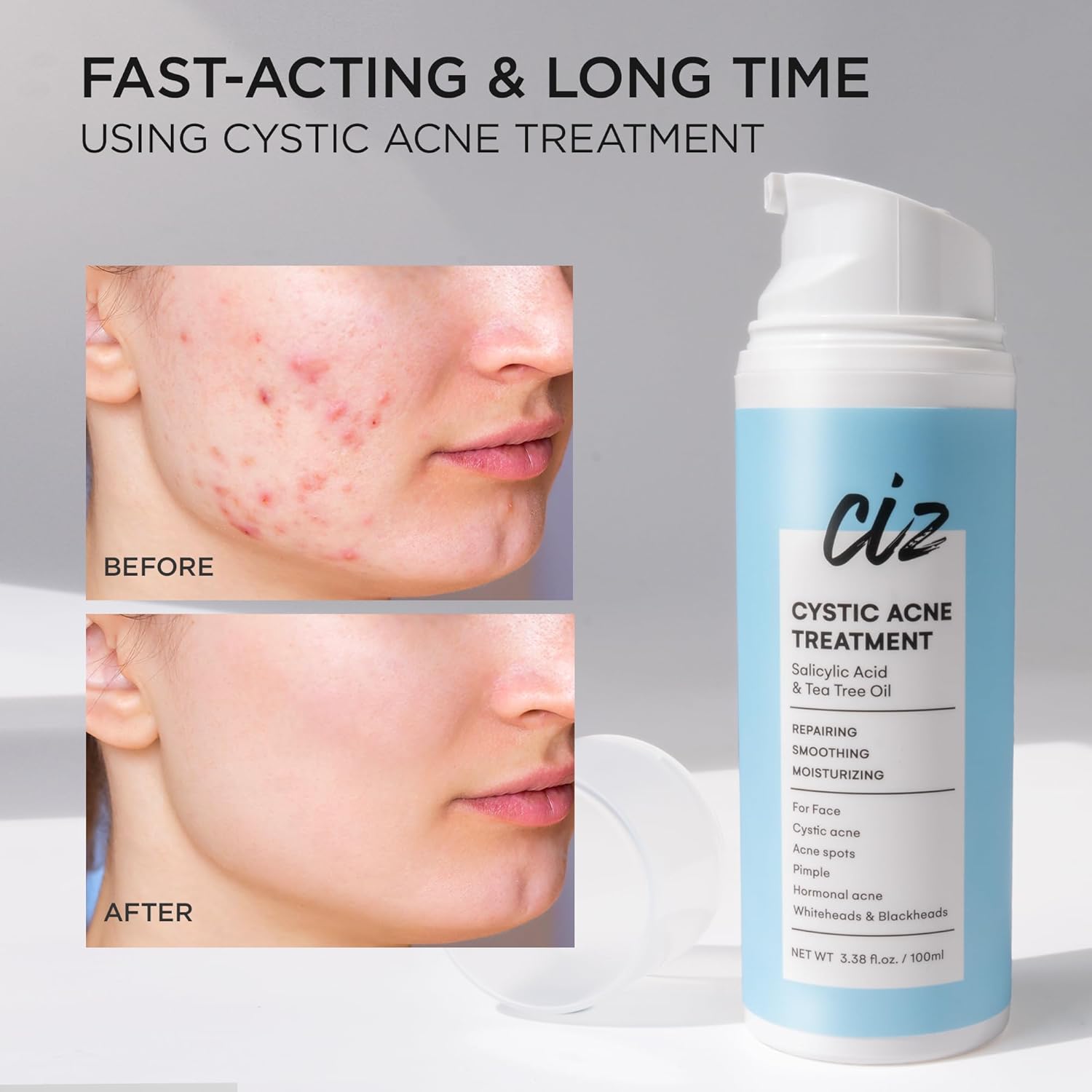 Acne Treatment for Face: Cystic Acne Spot Control Cream with Salicylic Acid & Tea Tree Oil for Blemishes - Gentle Hormonal & Pimple Treatment for Teens & Adults - 120 Day Supply & 3.38oz