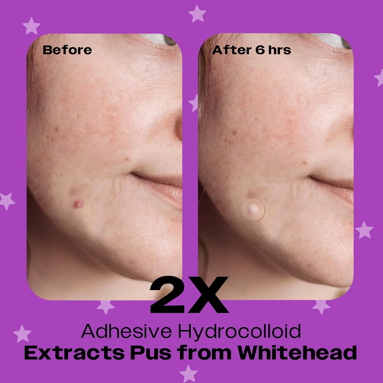 AVARELLE Spot Pimple Patches with Tea Tree Oil – Hydrocolloid Acne Care Patches, FSA/HSA Eligible