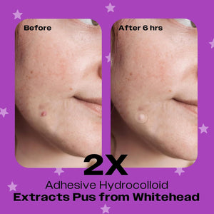 AVARELLE Spot Pimple Patches with Tea Tree Oil – Hydrocolloid Acne Care Patches, FSA/HSA Eligible