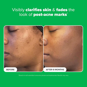 Paula's Choice BOOST 10% Azelaic Acid Booster Cream Gel, Licorice Extract & Salicylic Acid, Oil-Free Skin Brightening Serum