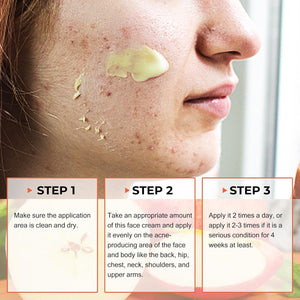 Acne Cream, Salicylic Acid Cystic Acne Treatment For Face, Back Butt Acne Treatments Creams, Acne Spot Treatment for Face Body, Acne Clearing Pimple Cream for Teens & Adults, Acne Moisturizer