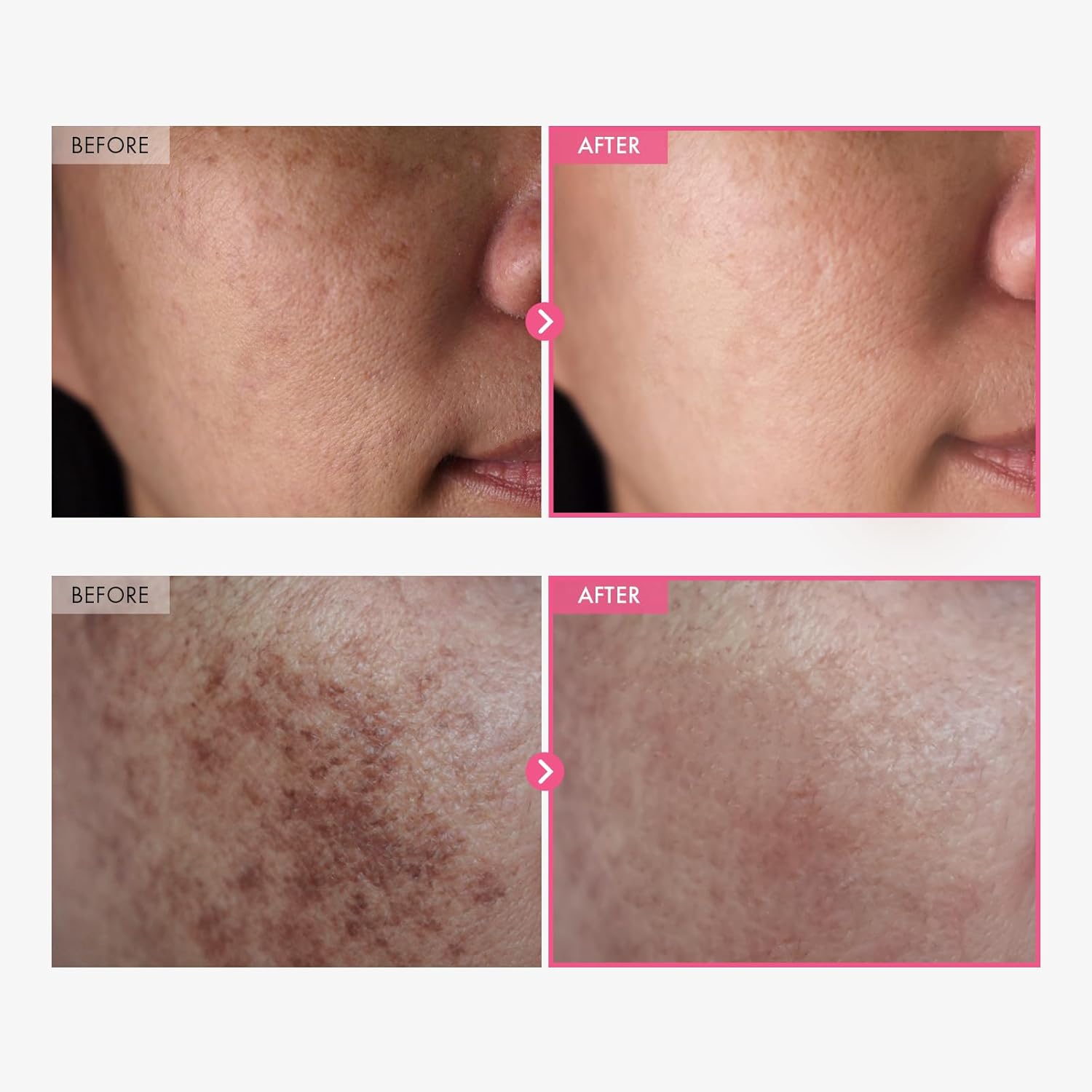 Arbutin 7% + Tranexamic Acid 4% Cream, 70,000ppm Arbutin, 40,000ppm TXA, Niacinamide, Glutathione, Dark Spots, Freckle, Blemishes, Pigmetation, Korean Skin Care, 50ml, 1.69 fl.oz.