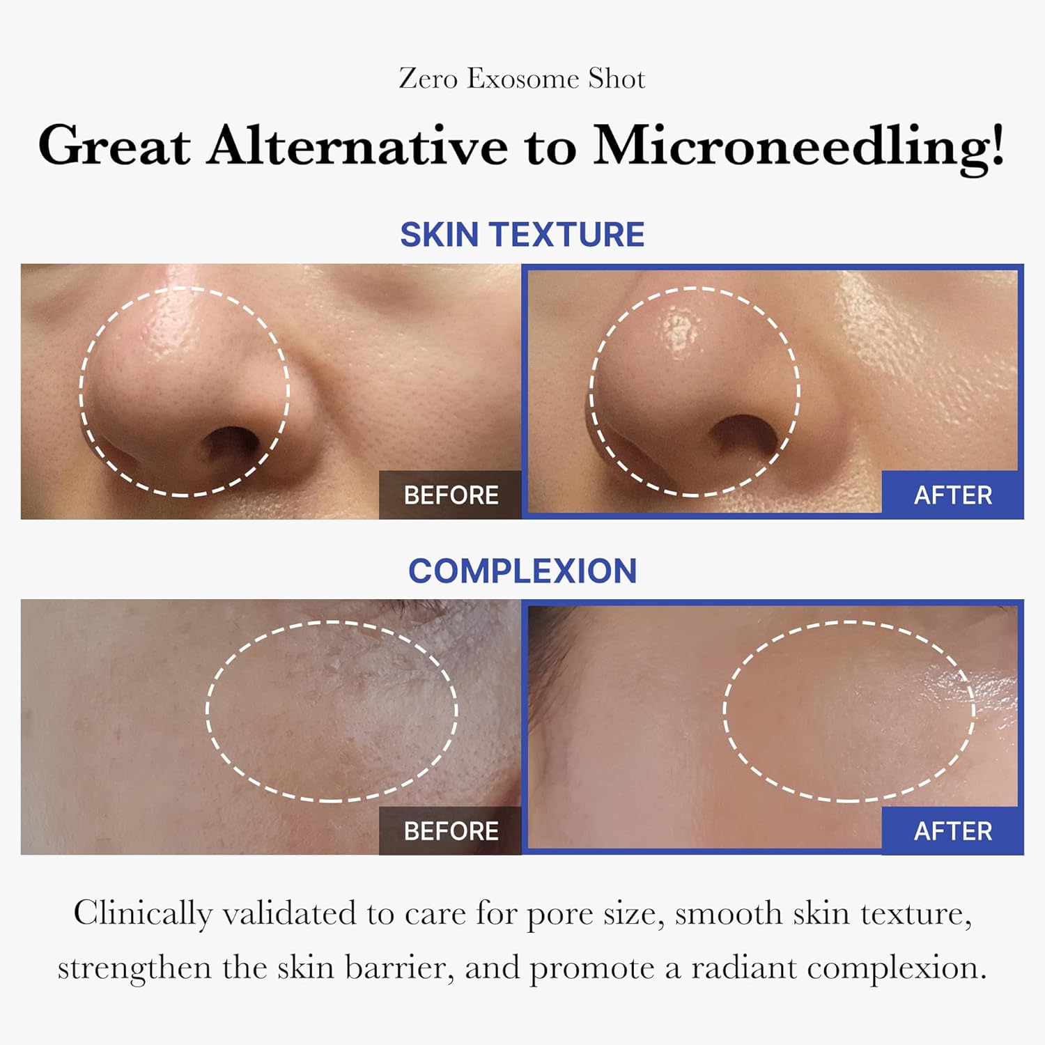 medicube Zero Exosome Shot 7,500 PPM Spicule Facial Serum | Liquid Skin Booster Serum | Exosome, AHA+BHA+PHA | Pore Care, Dead Skin Cells, Skin Texture | Korean Skin Care 1.01 fl.oz