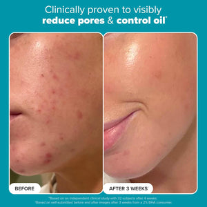 Paula's Choice SKIN PERFECTING 2% BHA Liquid Salicylic Acid Exfoliant-Facial Exfoliant for Blackheads, Enlarged Pores, Wrinkles & Fine Lines