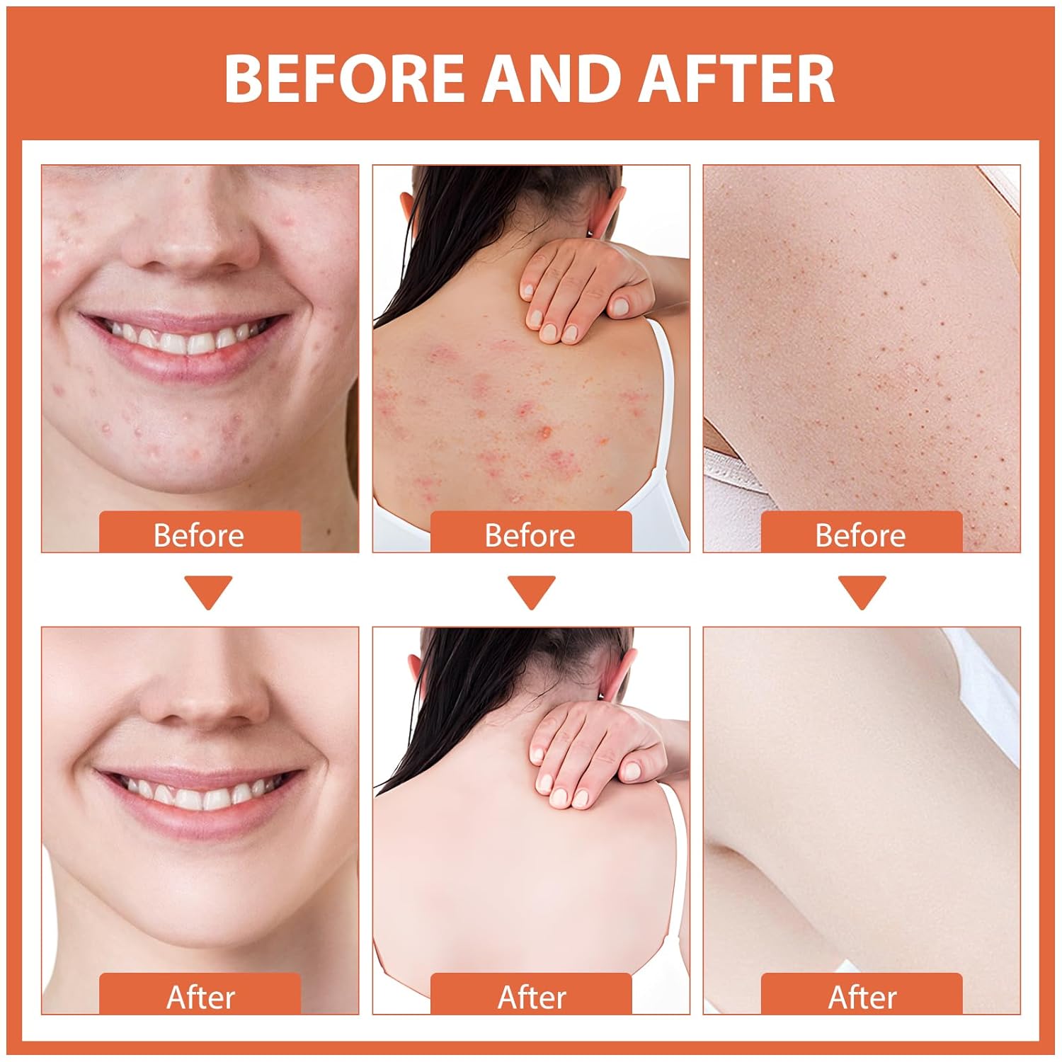 Acne Cream, Salicylic Acid Cystic Acne Treatment For Face, Back Butt Acne Treatments Creams, Acne Spot Treatment for Face Body, Acne Clearing Pimple Cream for Teens & Adults, Acne Moisturizer