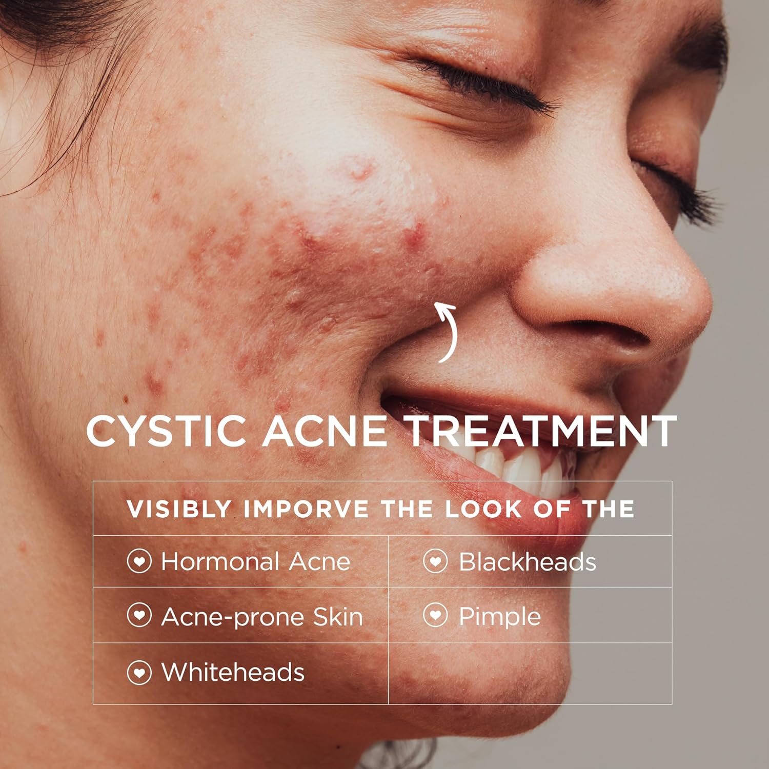 Acne Treatment for Face: Cystic Acne Spot Control Cream with Salicylic Acid & Tea Tree Oil for Blemishes - Gentle Hormonal & Pimple Treatment for Teens & Adults - 120 Day Supply & 3.38oz